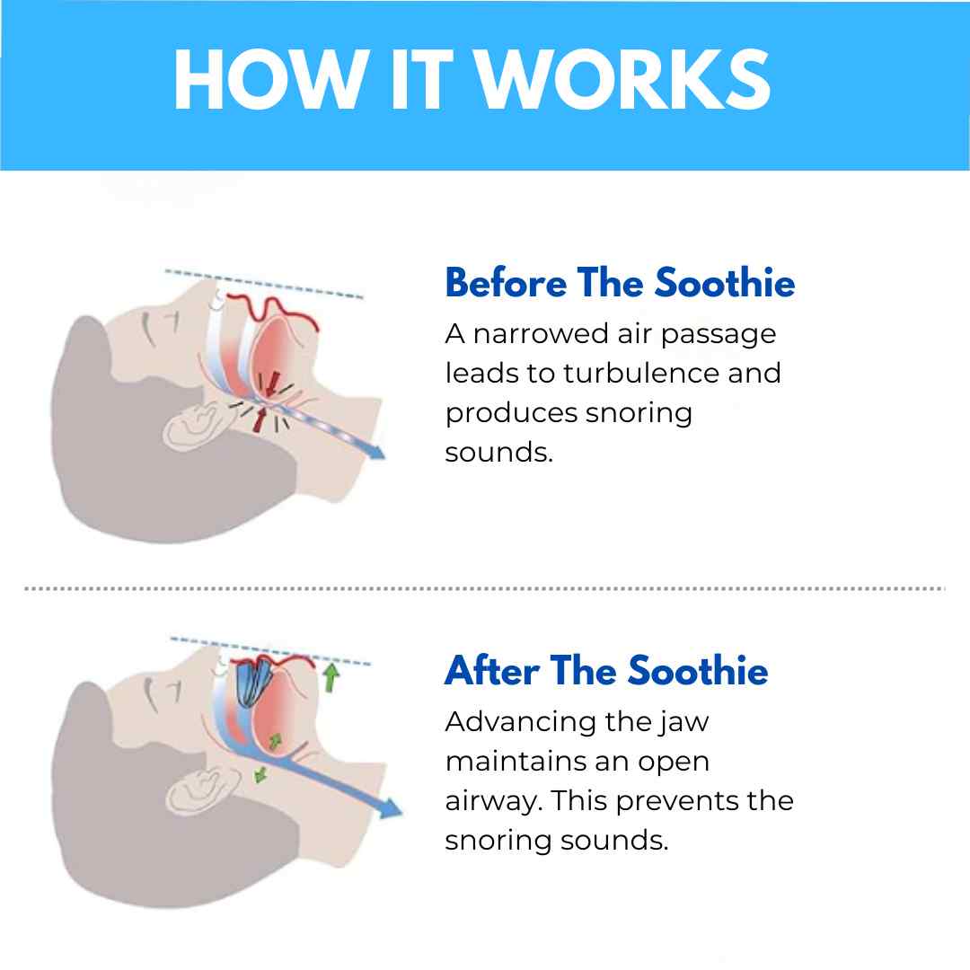 SilentGuard™ Anti-Snore Mouthpiece Buy 1 Get 1 Free