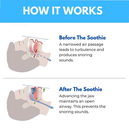 SilentGuard™ Anti-Snore Mouthpiece Buy 1 Get 1 Free